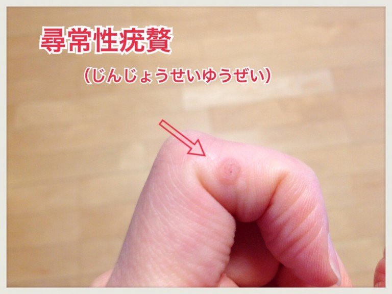 魚の目の危険な落とし穴!手の指にできた魚の目、それはウイルス性のイボでした! 続こたつむり主婦の気ままな暮らし 魚の目の危険な落とし穴!手の指にできた魚の目、それはウイルス性のイボでした! 続こたつむり主婦の気ままな暮らし